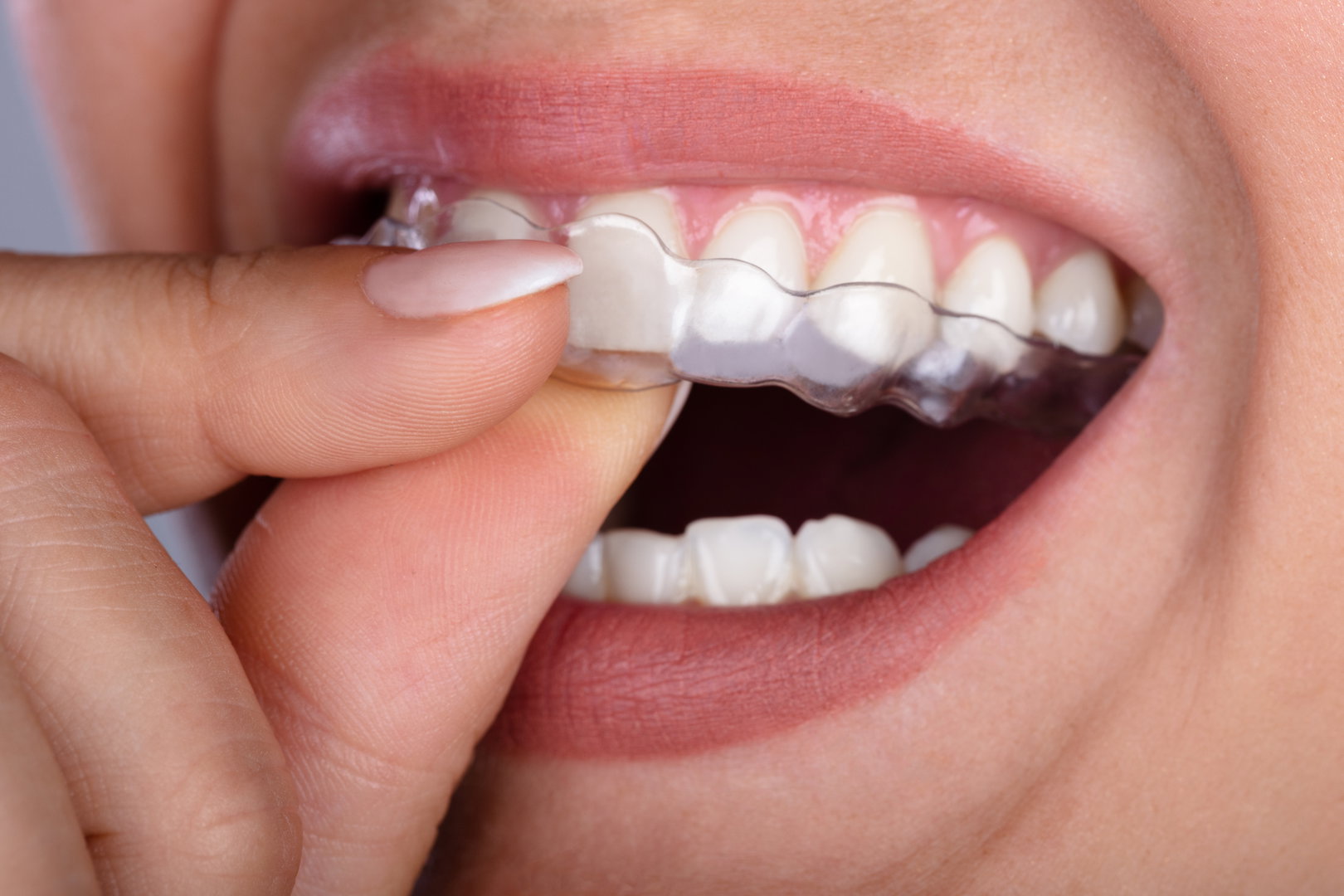 invisalign-adult3