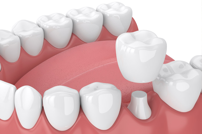 Dental Crowns in North Richland Hills