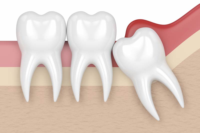 Wisdom Tooth Removal in North Richland Hills
