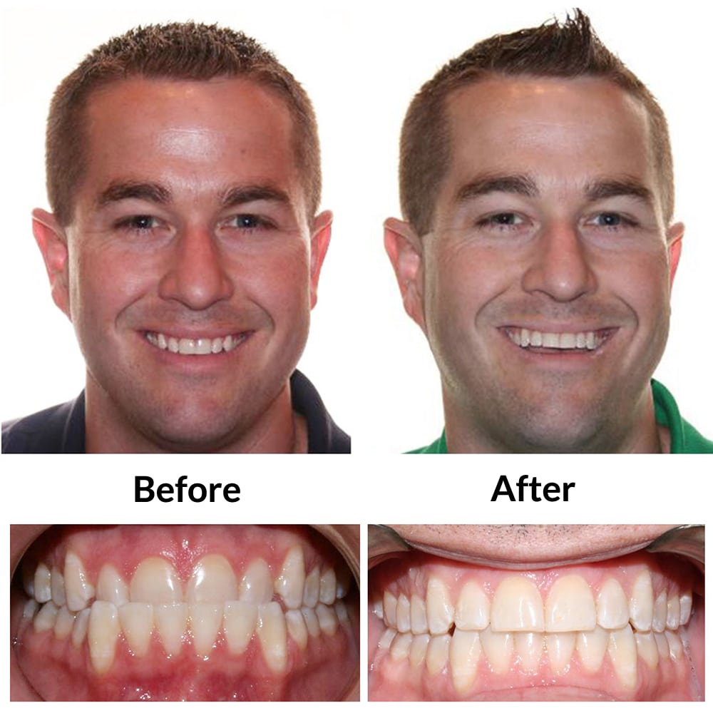 Invisalign Before and After 3
