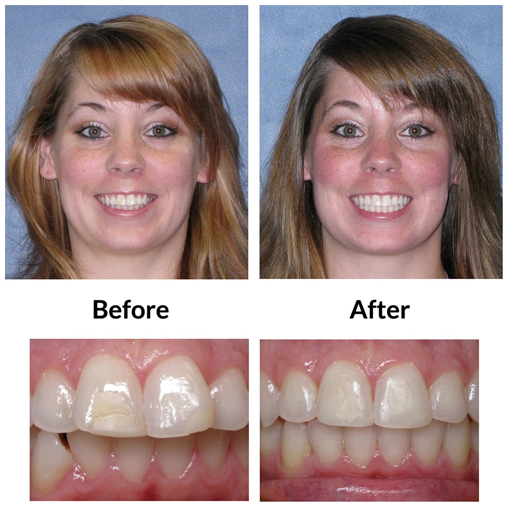 Invisalign Before and After 2