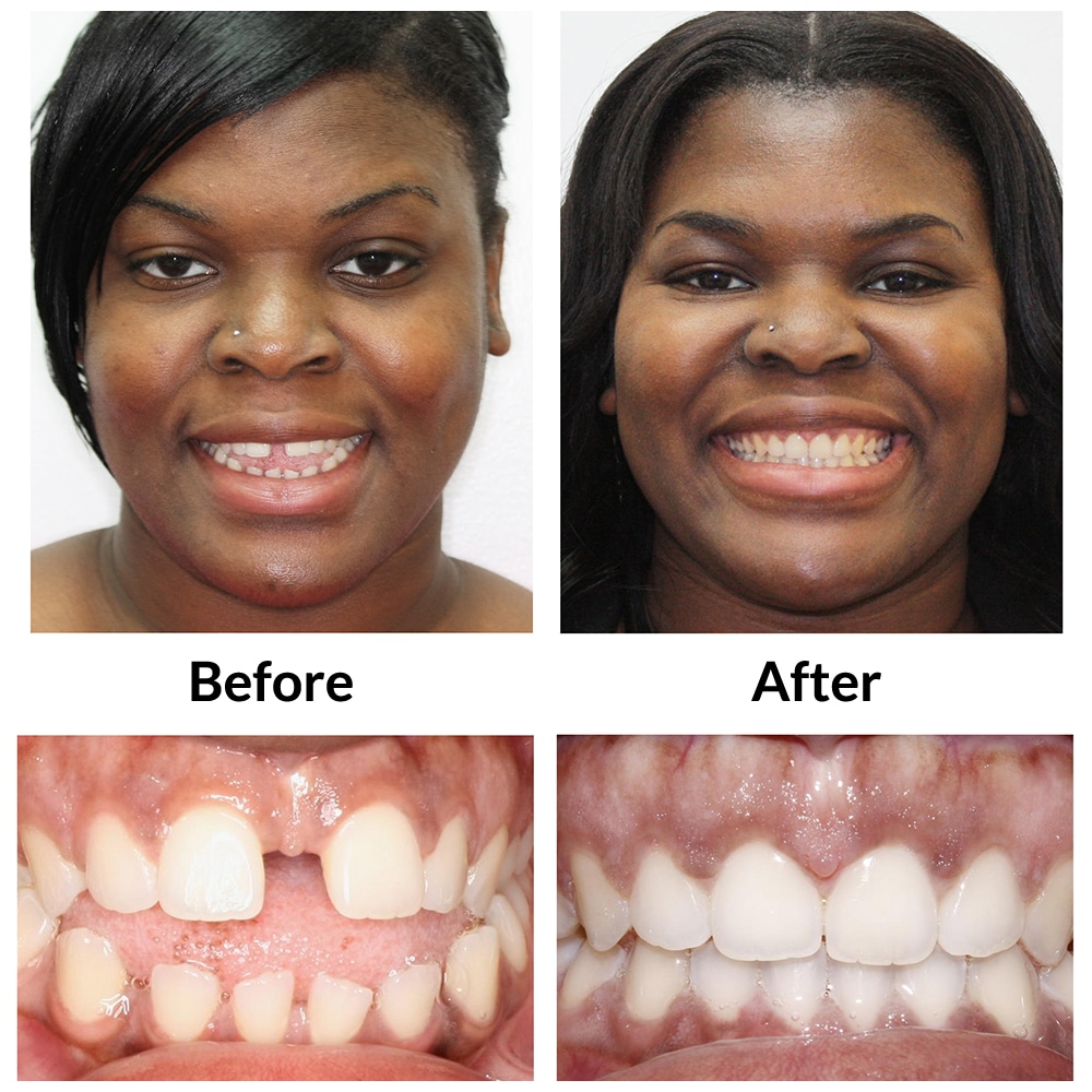 Invisalign Before and After 1