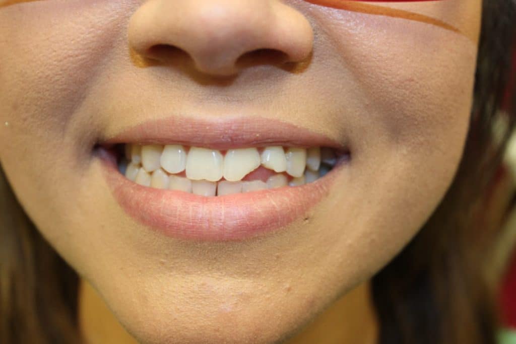 Smiling woman with a chipped front tooth.
