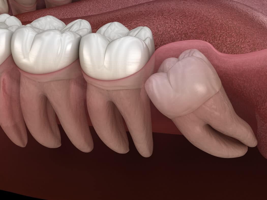 illustration of an impacted wisdom tooth