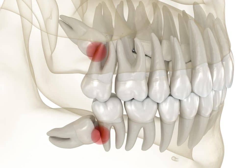 illustration of impacted wisdom teeth