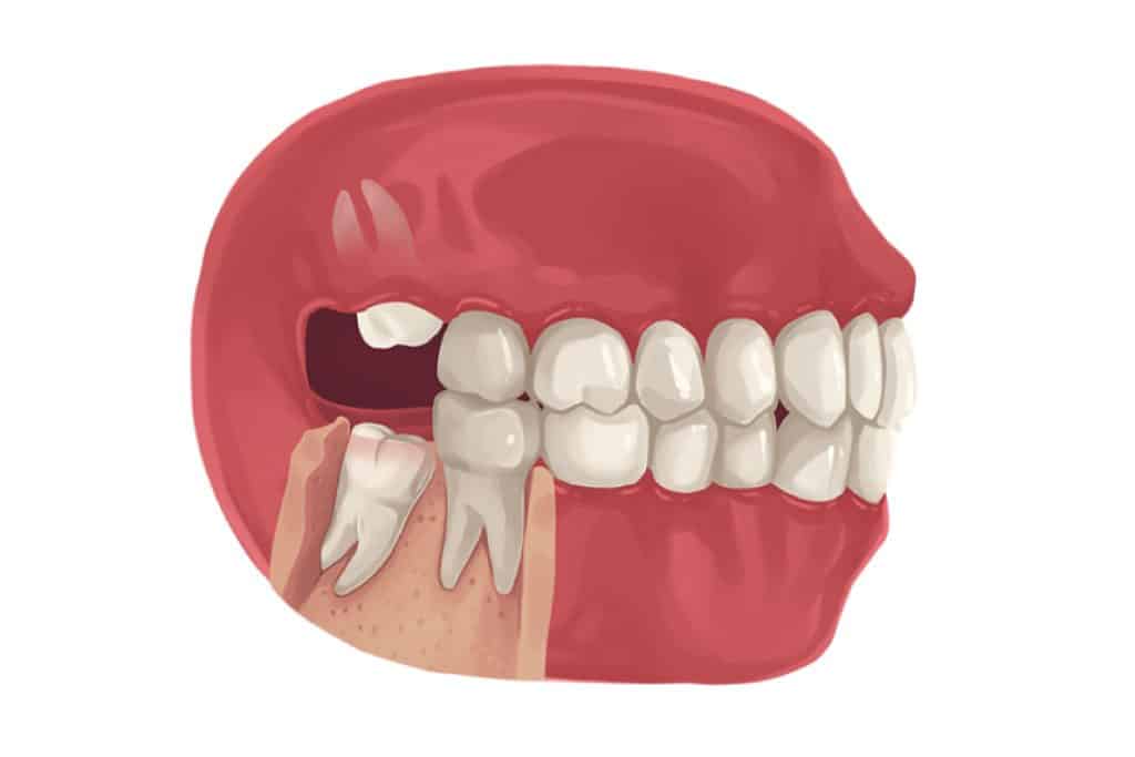 Model of a mouth showing wisdom teeth growing in at bad angles.