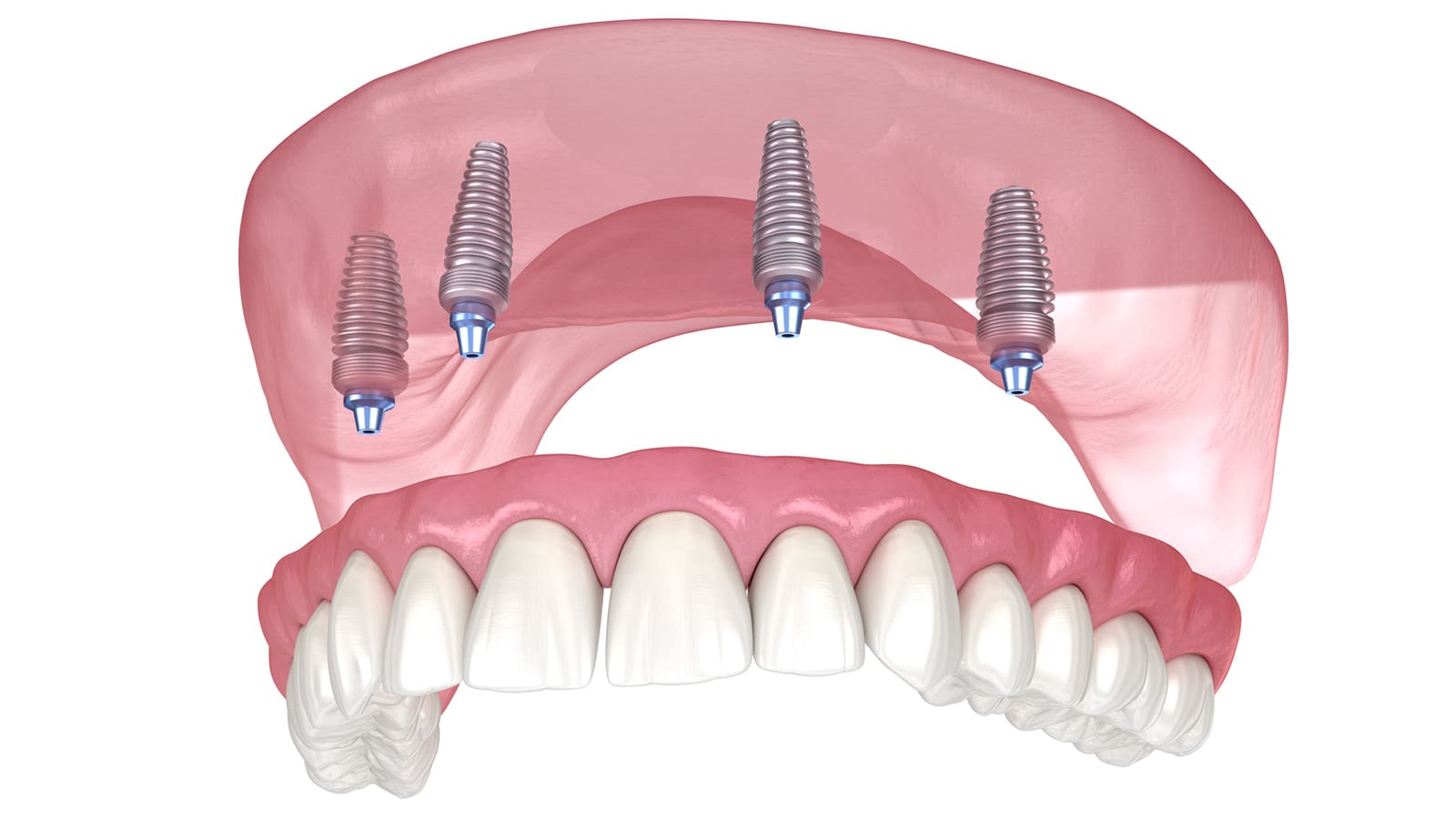 Illustration of Dentures