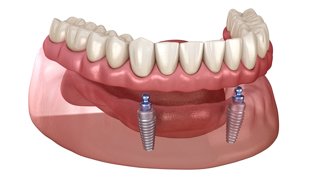 Implant Retained Dentures Photo