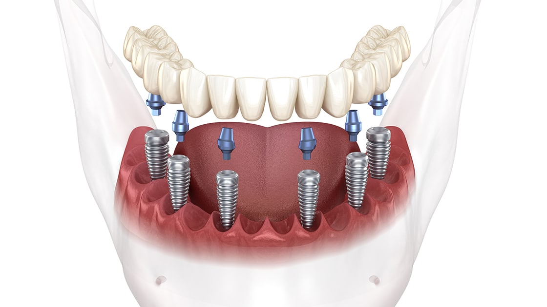Implant Supported Dentures Photo