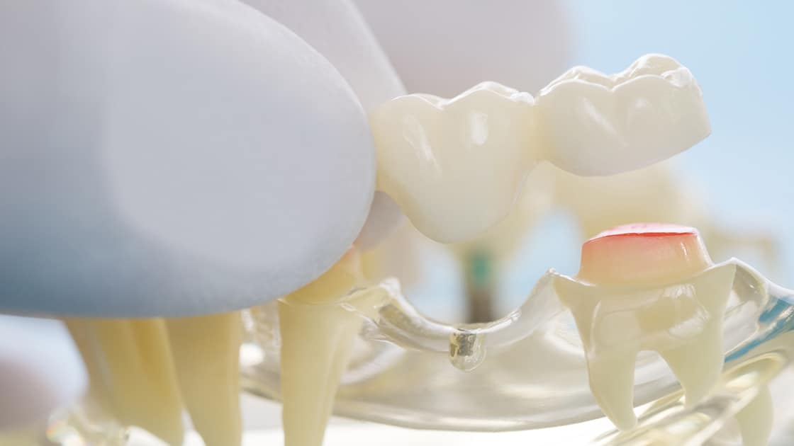 Dental Bridge Model Photo