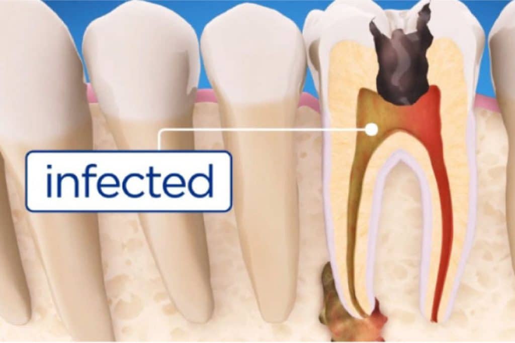 illustration of a root canal