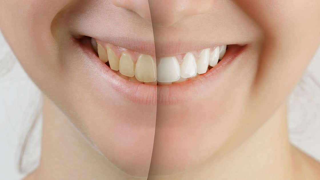 Before and After Image of Whitened Teeth